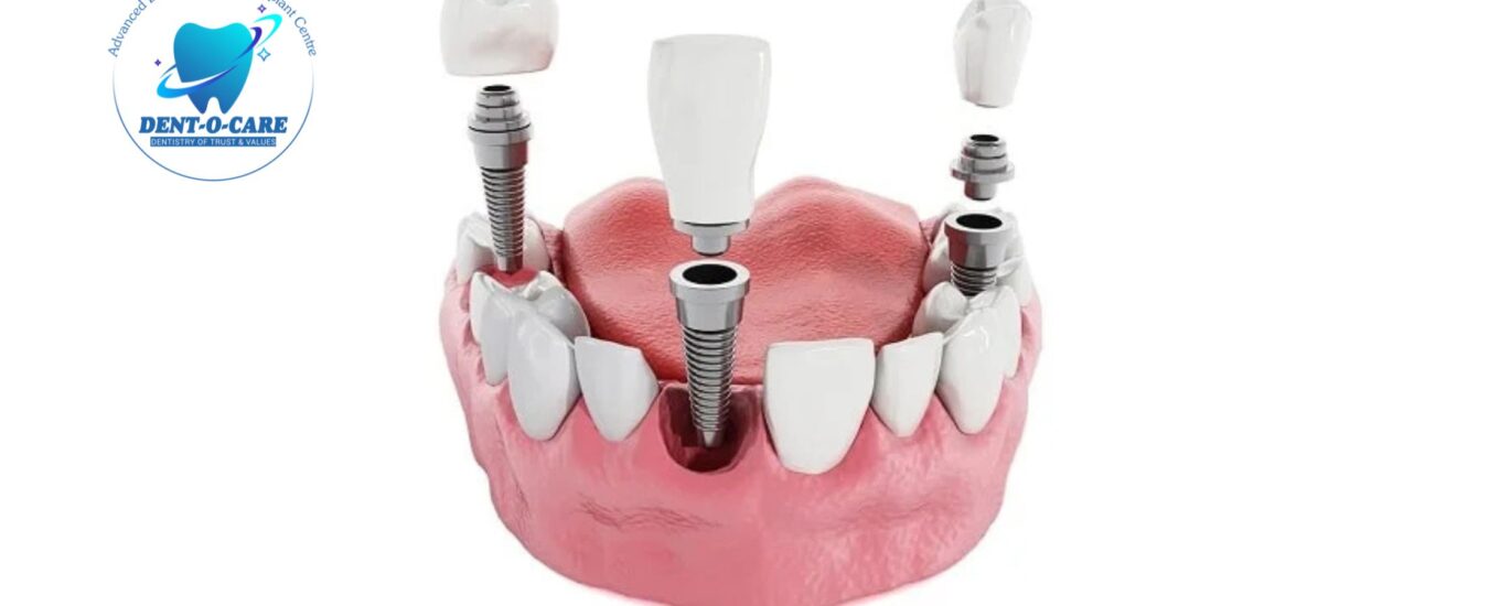 Best Dental Implants: Everything You Should Know