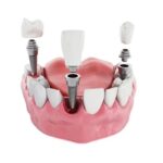Best Dental Implants: Everything You Should Know