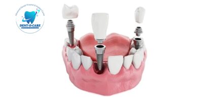 Best Dental Implants: Everything You Should Know
