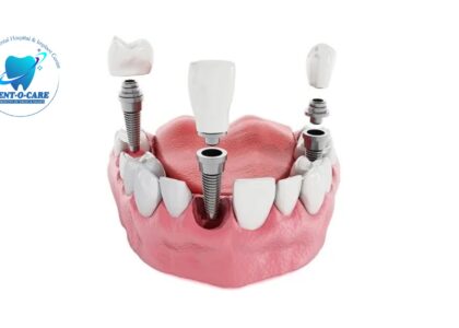 Best Dental Implants: Everything You Should Know