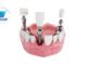 Best Dental Implants: Everything You Should Know