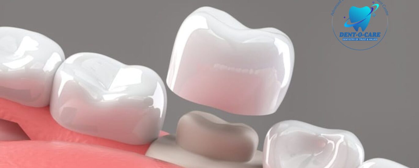 teeth cap cost in india