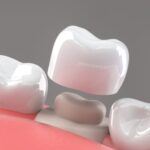 teeth cap cost in india