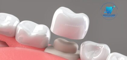 teeth cap cost in india