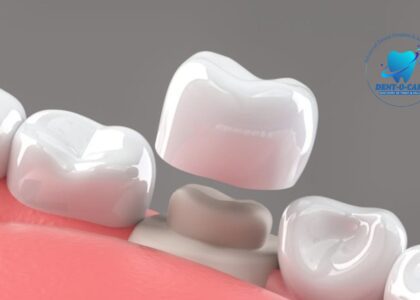 teeth cap cost in india