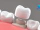 teeth cap cost in india