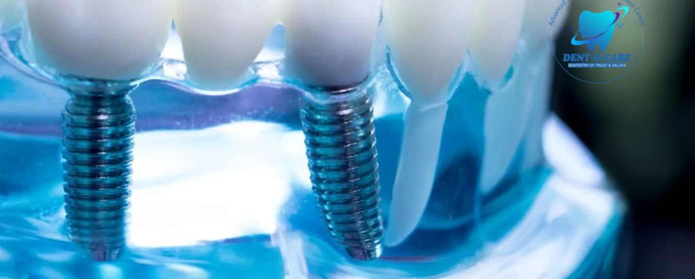The Best Dental Implants: A Complete Guide to Restoring Your Smile