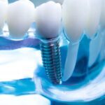 The Best Dental Implants: A Complete Guide to Restoring Your Smile
