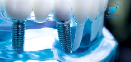 The Best Dental Implants: A Complete Guide to Restoring Your Smile