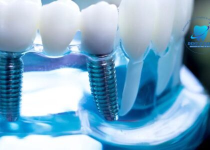 The Best Dental Implants: A Complete Guide to Restoring Your Smile
