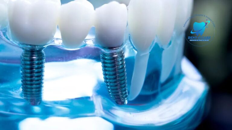 The Best Dental Implants: A Complete Guide to Restoring Your Smile | Dent-O-Care