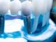 The Best Dental Implants: A Complete Guide to Restoring Your Smile