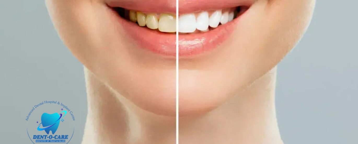 Teeth Whitening: Everything You Need to Know for a Brighter Smile