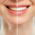 Teeth Whitening: Everything You Need to Know for a Brighter Smile