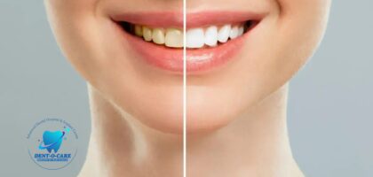 Teeth Whitening: Everything You Need to Know for a Brighter Smile