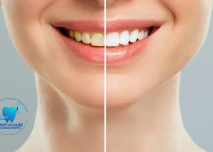 Teeth Whitening: Everything You Need to Know for a Brighter Smile