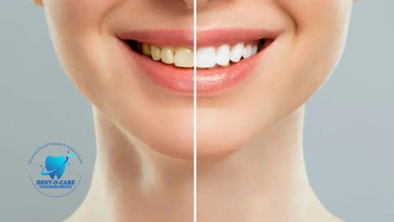Teeth Whitening: Everything You Need to Know for a Brighter Smile | Dent-O-Care
