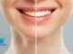 Teeth Whitening: Everything You Need to Know for a Brighter Smile