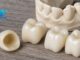 Top 10 Strong Reasons Why Choose Zirconia Crown