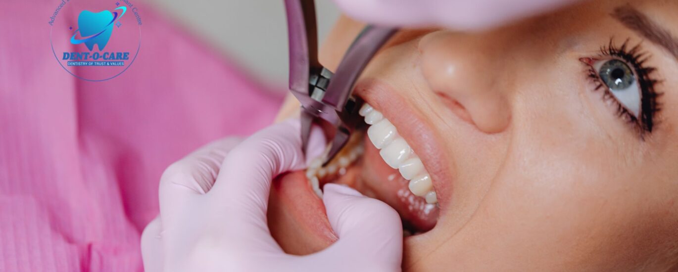 Reasons for Dental Implants for Missing Teeth